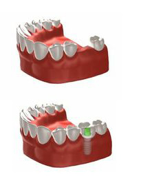 Straumann dental Implants sussex