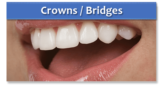 Crowns and bridges