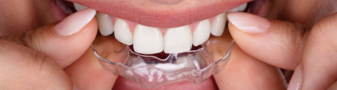 Cosmetic dentistry Horsham - woman putting transparent aligner in top teeth